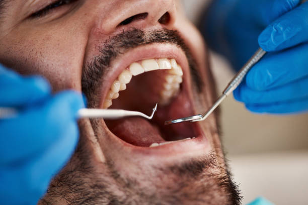 Best Emergency Wisdom Tooth Extraction in Milaca, MN